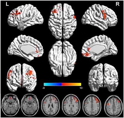 Aberrant structural and functional alterations in postpartum depression: a combined voxel-based morphometry and resting-state functional connectivity study